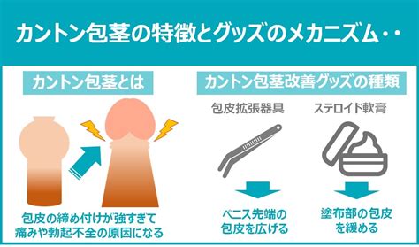 かんとんほう|【医師執筆】カントン包茎を自力で治すことは可能なのか？ – メ。